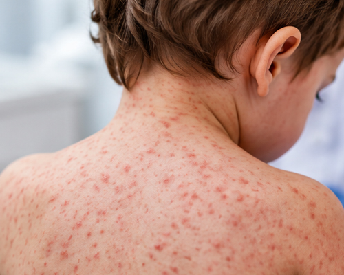 Rougeole aux États-Unis : plus de 4 000 cas, le retour inquiétant d’une maladie évitable