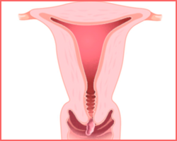 Cancers du col de l’utérus : Le premier test sanguin de diagnostic mis en place
