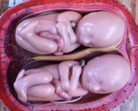 Deux «fœtus» découverts dans le ventre d'un nouveau-né