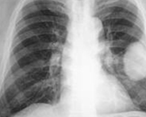 L’AMRM célèbre la Journée mondiale de la fibrose pulmonaire idiopathique 